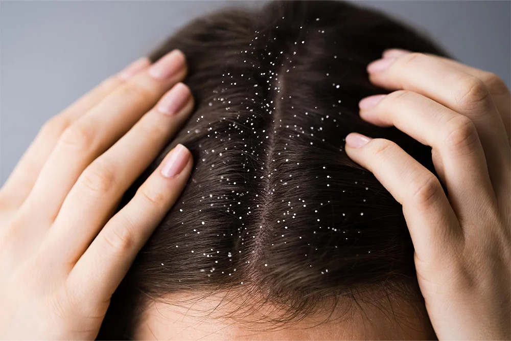 Winter Dandruff